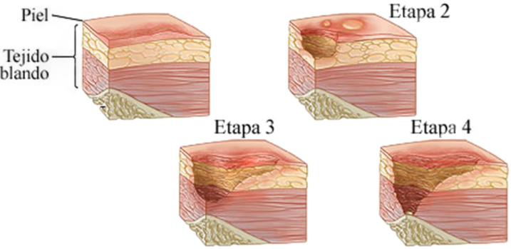 niveles de ulceras
